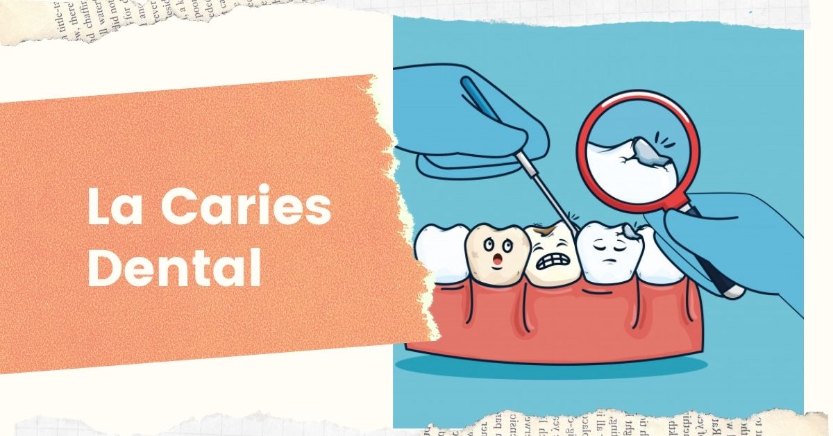 ¿Que es La Caries Dental?